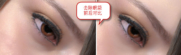去除眼袋前后对比